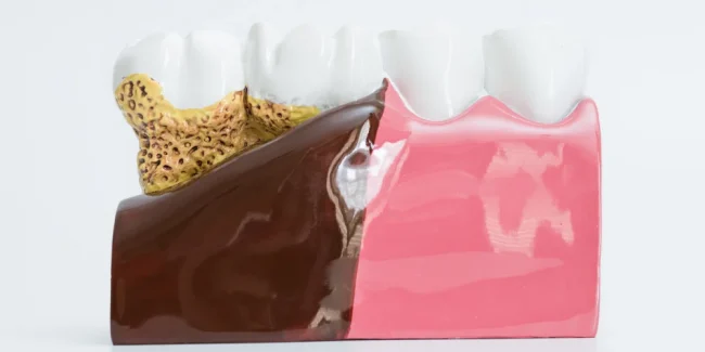 dis-curugu-ve-curuk-tedavisi